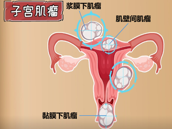 【女性必看！】子宫肌瘤——每5个女人，就有1个中招！