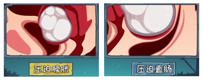 【女性必看！】子宫肌瘤——每5个女人，就有1个中招！