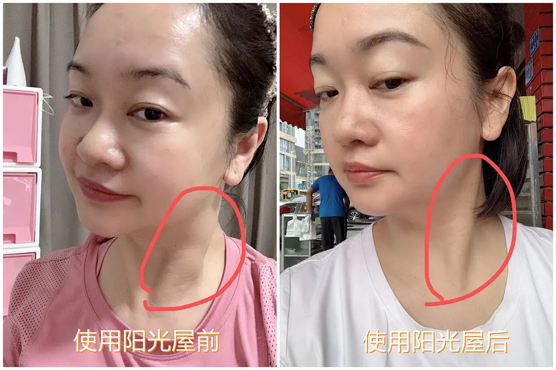 晏春梅-淋巴结节对比(前)_副本.jpg 图片