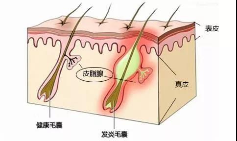 皮肤的油脂分泌旺盛