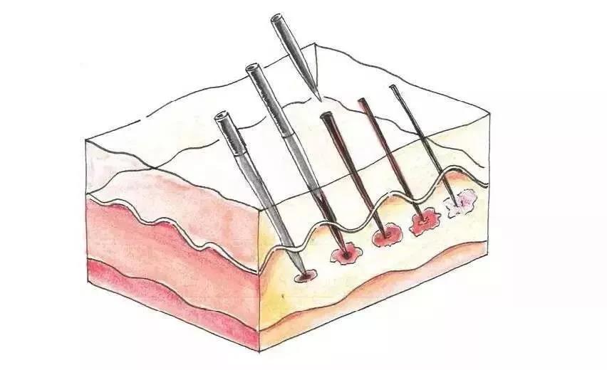 微针祛痘
