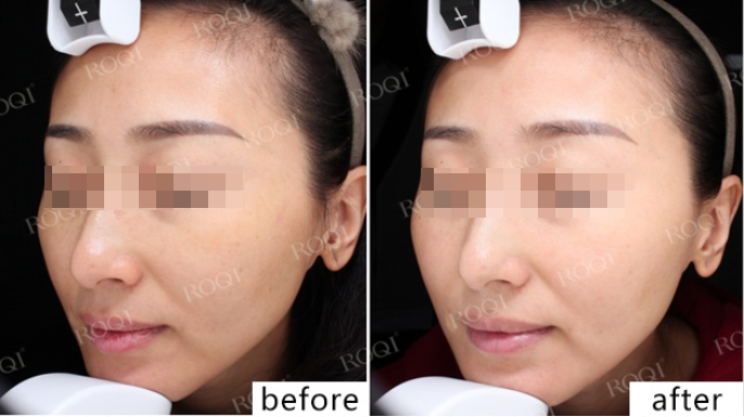 若清净颜靓肤修护套组真实案例