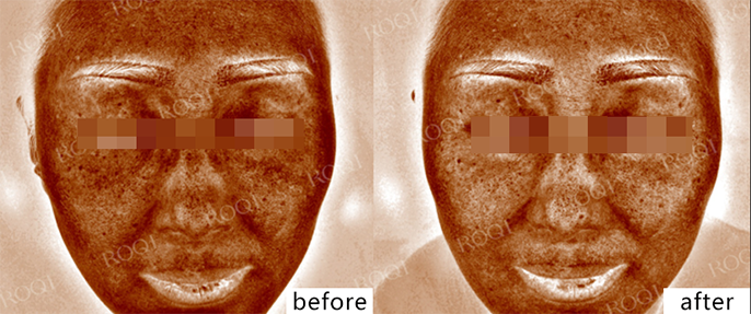 若清净颜靓肤修护套组真实案例