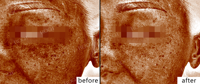 若清净颜靓肤修护套组真实案例