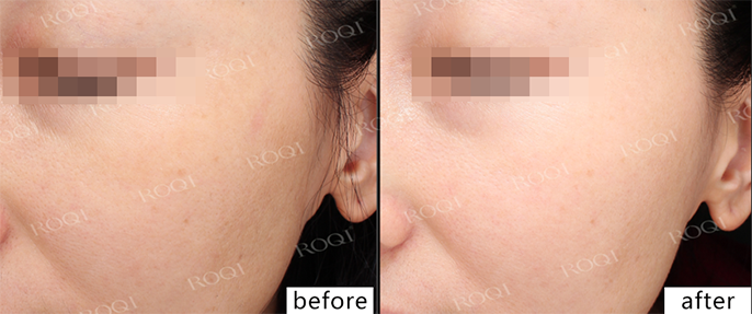 若清净颜靓肤修护套组真实案例